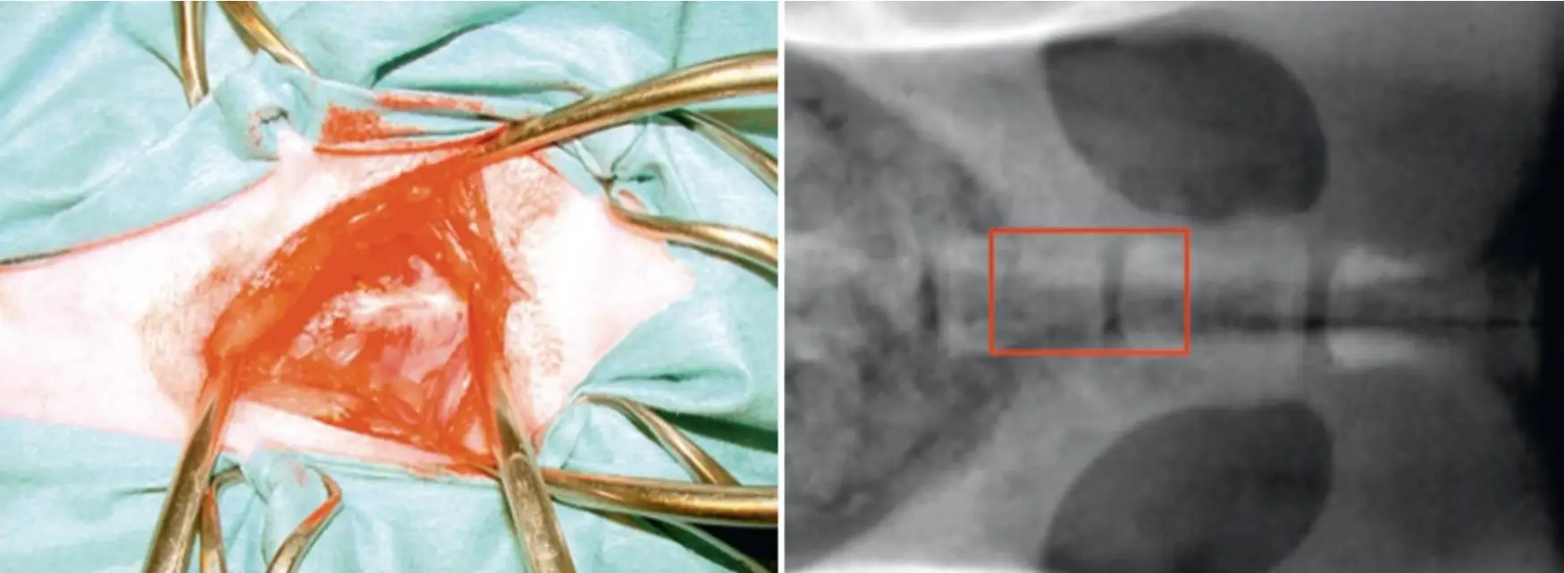 Side-by-side images showing a surgical spinal exposure on the left and an X-ray with a highlighted spinal area on the right.