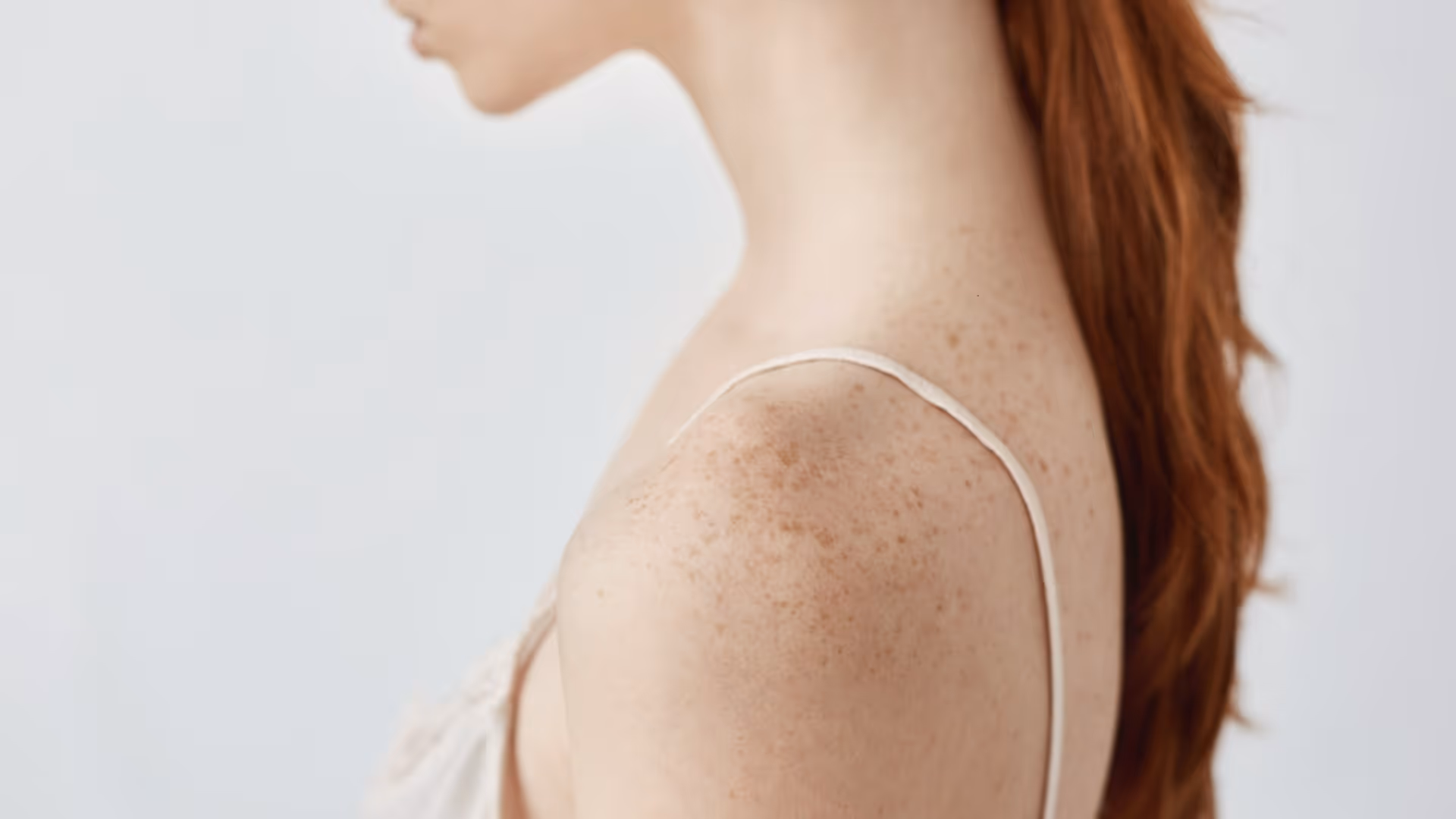 Femme de profil aux cheveux roux, épaule présentant de nombreuses taches pigmentées brunes, sur fond blanc clair
