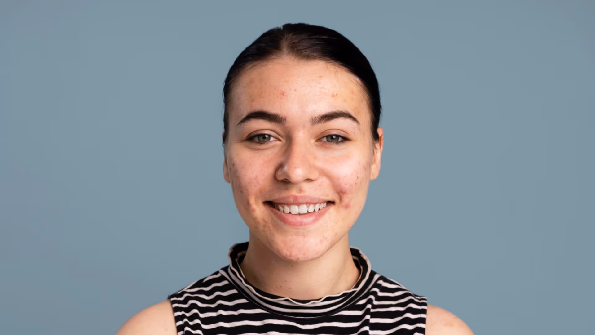 Portrait d'une jeune femme souriante présentant des imperfections acnéiques sur le visage, cheveux attachés, t-shirt rayé, sur fond bleu grisé