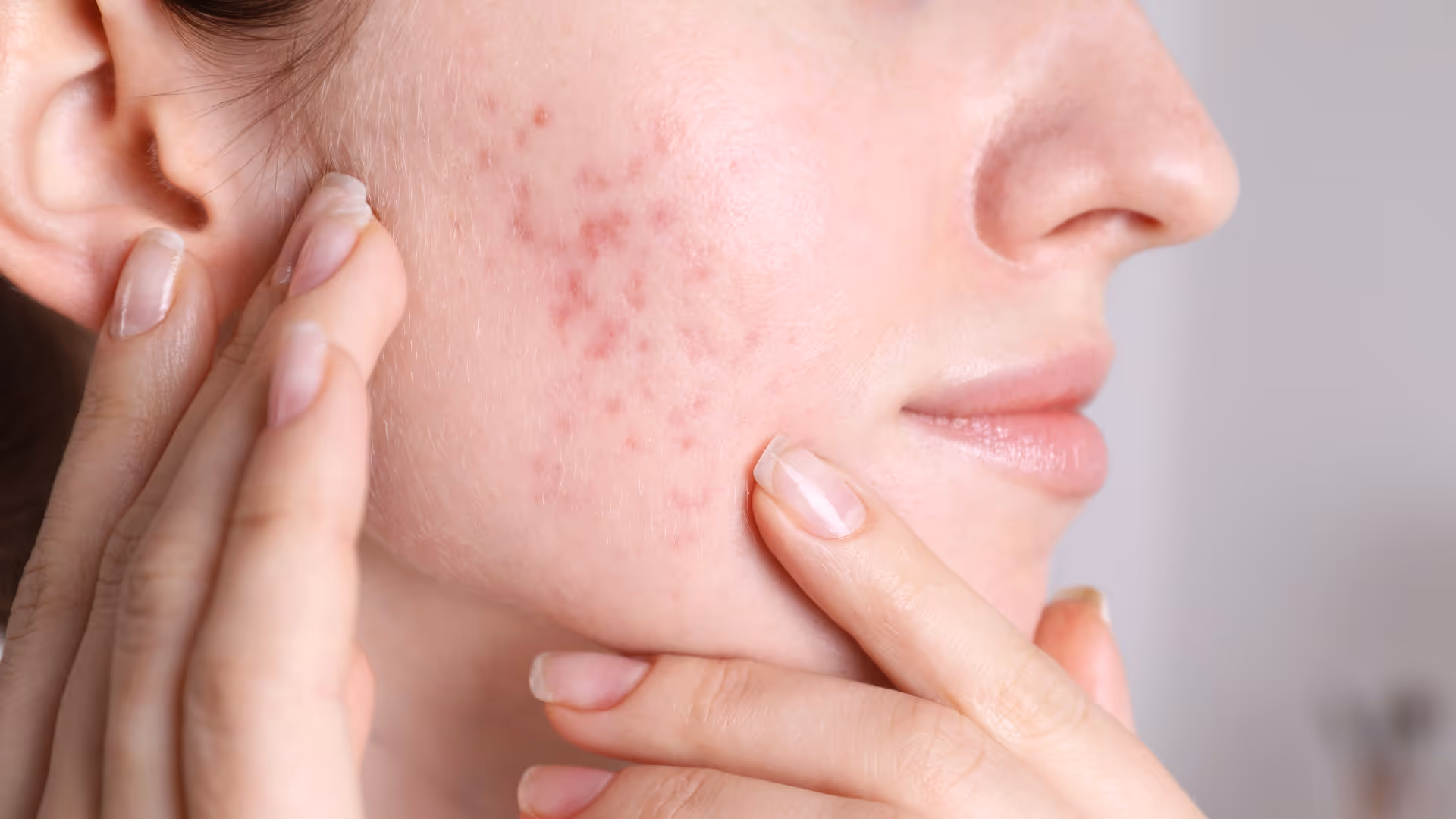Praticienne avec gants bleus appliquant un dispositif Hydrafacial® sur le front d'une femme allongée avec charlotte, en cabinet esthétique