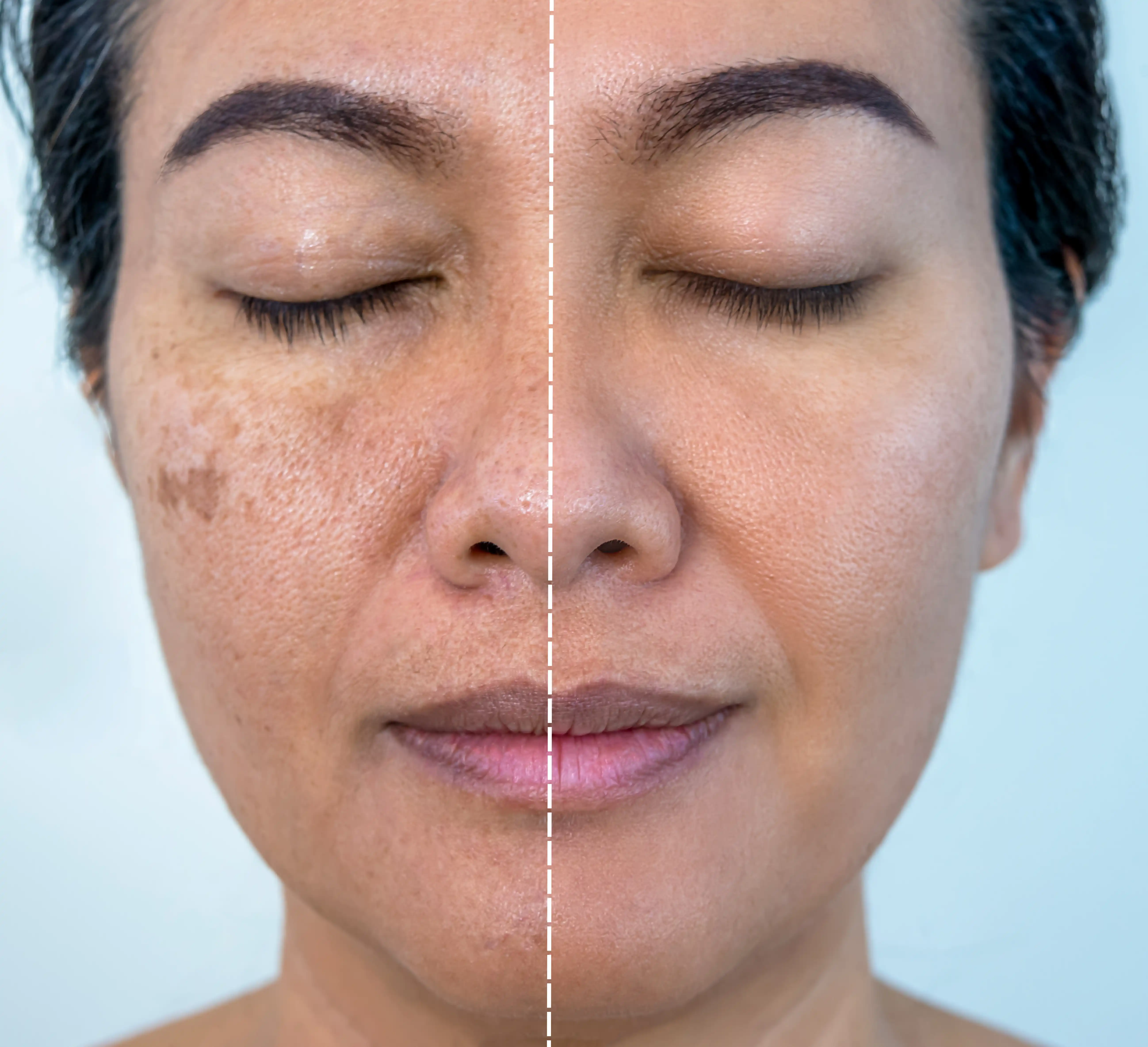 Dye-VL Pigmentation Treatment