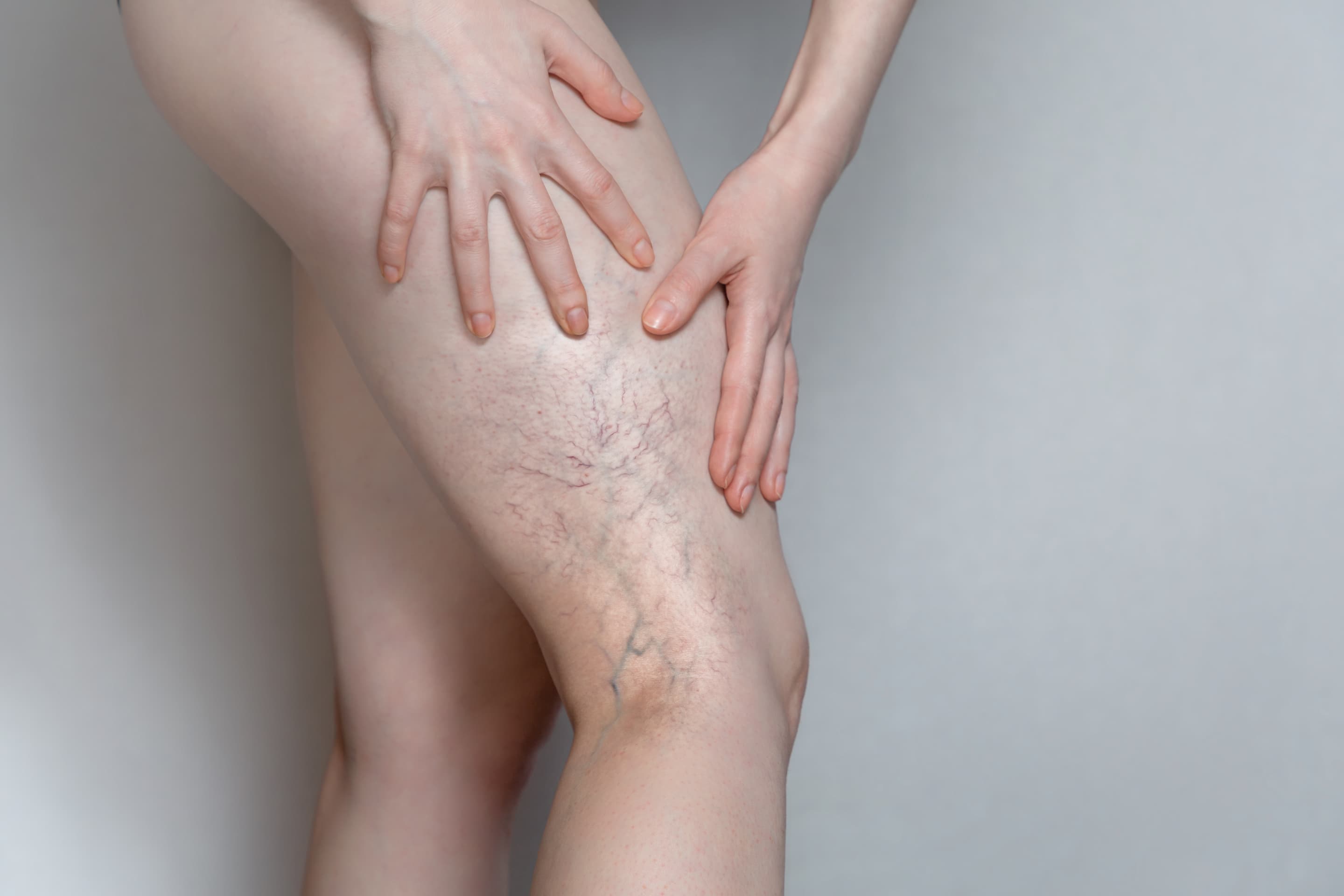 VascuLas Spider Vein Treatment