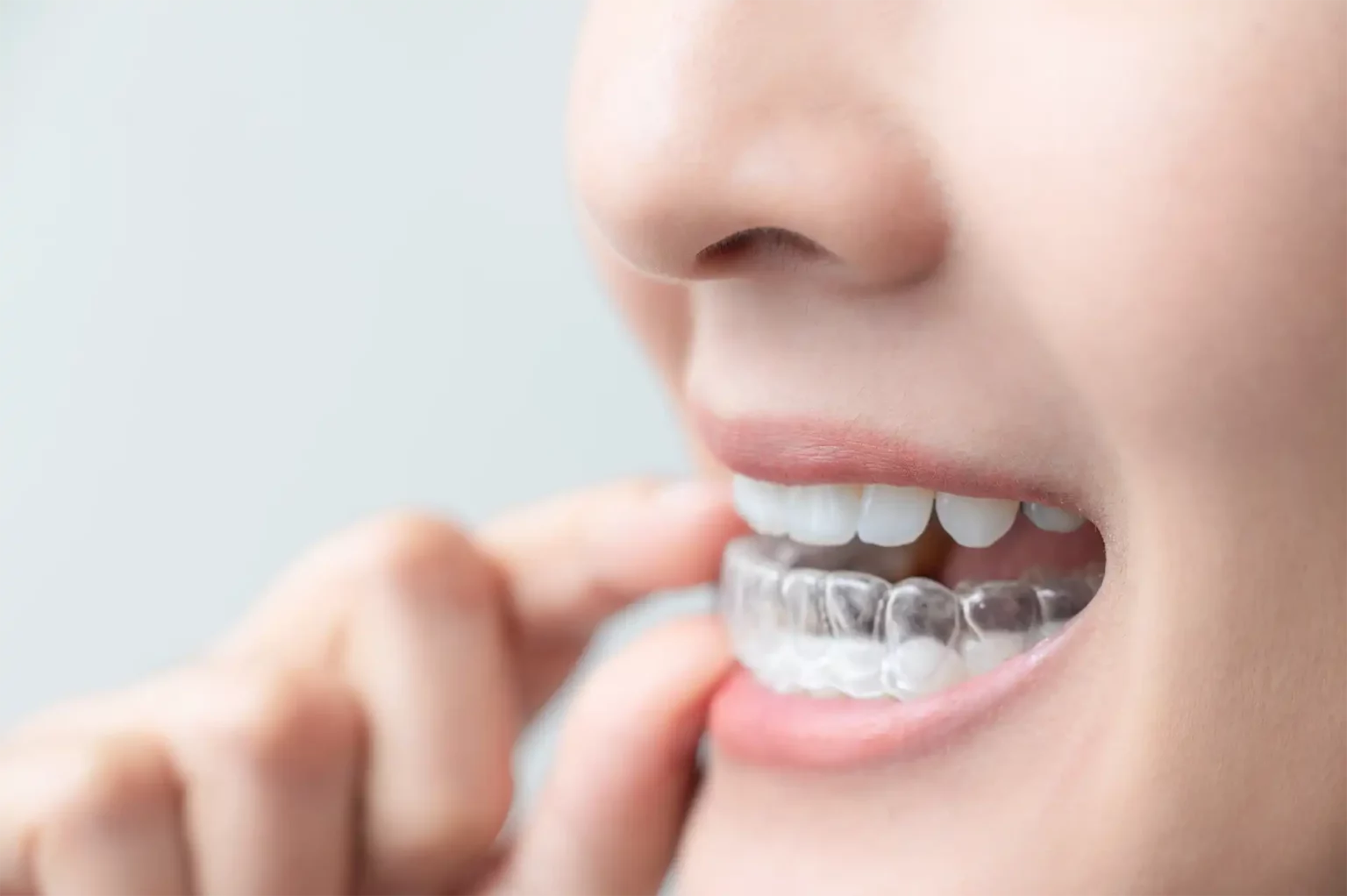 All You Need to Know About Clear Aligners