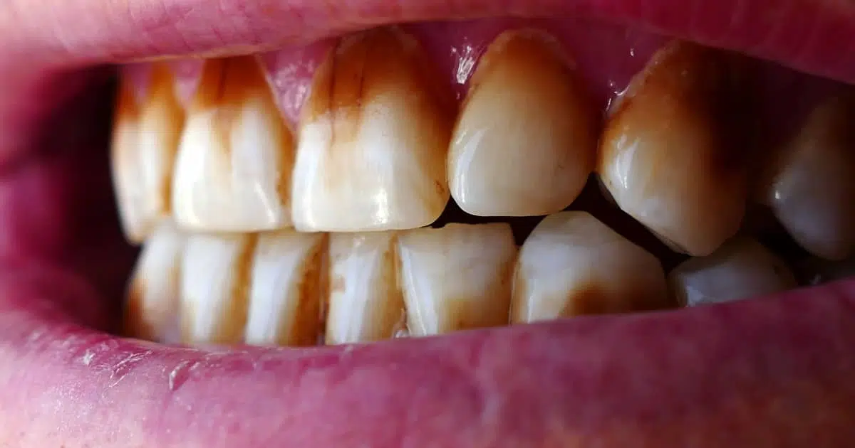 What To Do If Teeth Whitening Won’t Remove Stains On Teeth