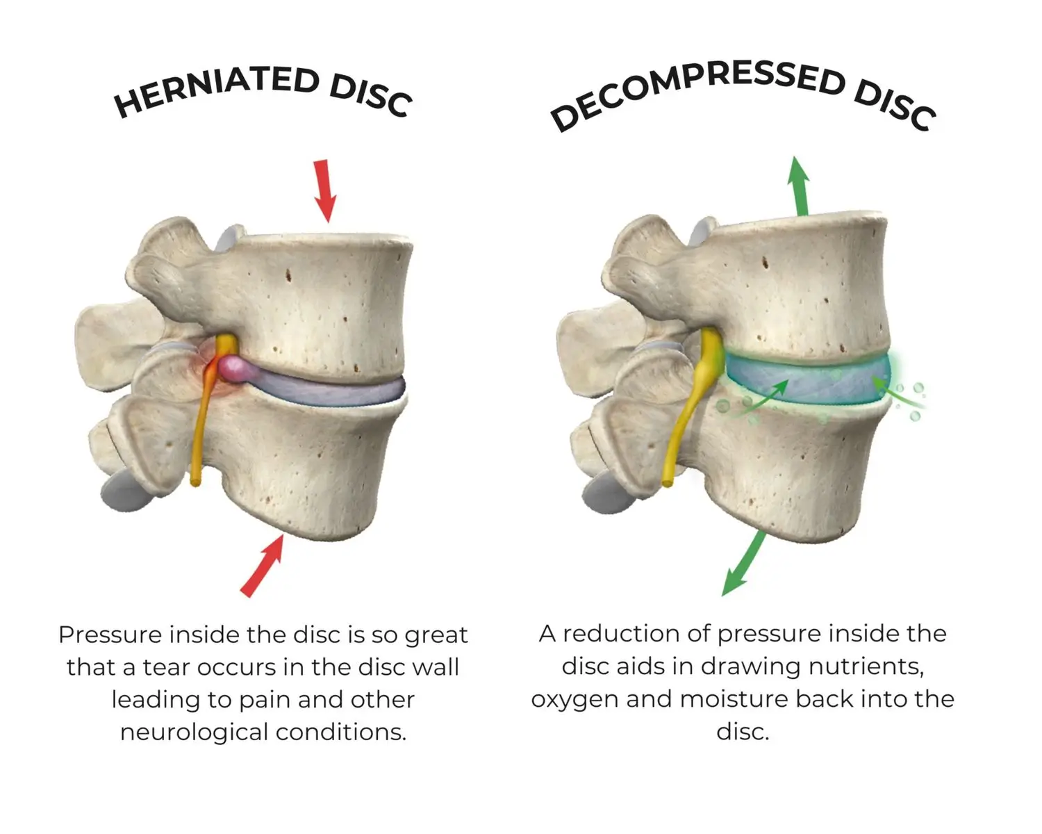 Side-by-side medical illustration comparison of a herniated disc and a decompressed disc in the spine. The herniated disc shows a tear in the disc wall causing pressure on a nearby nerve, indicated by a red arrow and red inflammation area. Text explains the pressure causes pain and neurological issues. The decompressed disc shows reduced pressure with a green arrow and blue-green shading, indicating nutrients, oxygen, and moisture drawing back into the disc, supporting disc health.
