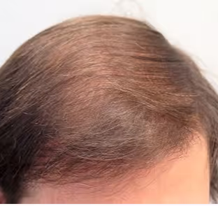 Foto hoofdhuid na Fellos haaruitval behandeling met finasteride of minoxidil