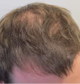 Foto hoofdhuid voor Fellos haaruitval behandeling met finasteride of minoxidil