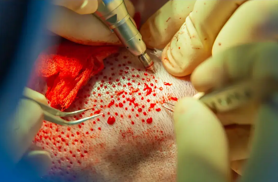 Une greffe de cheveux est-elle douloureuse ? Informations et conseils de Fellos