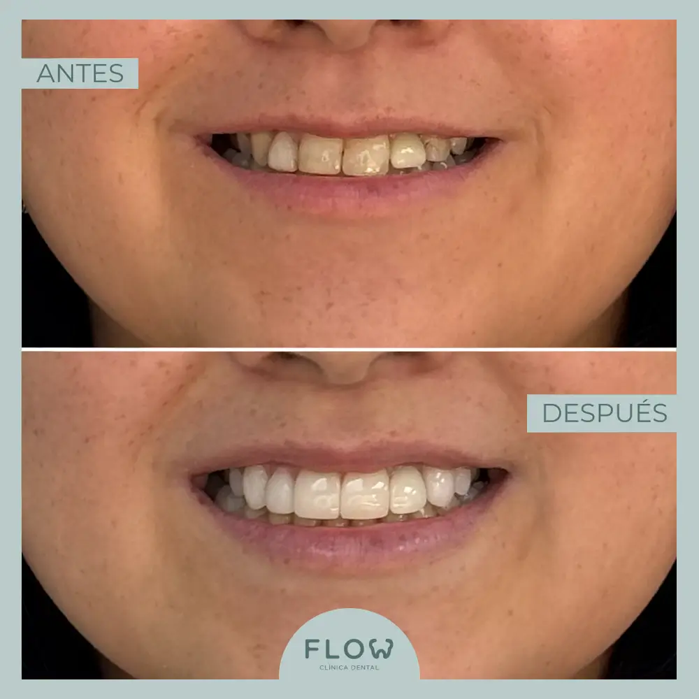 Antes y Después de tratamiento