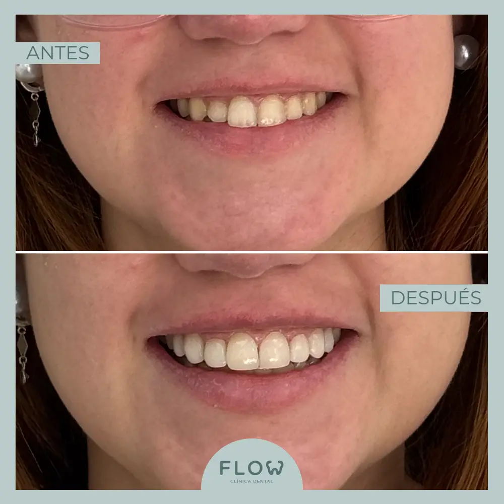 Antes y Después de tratamiento