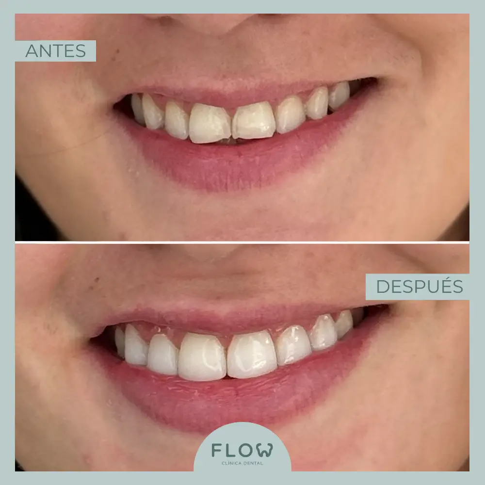 Antes y Después de tratamiento