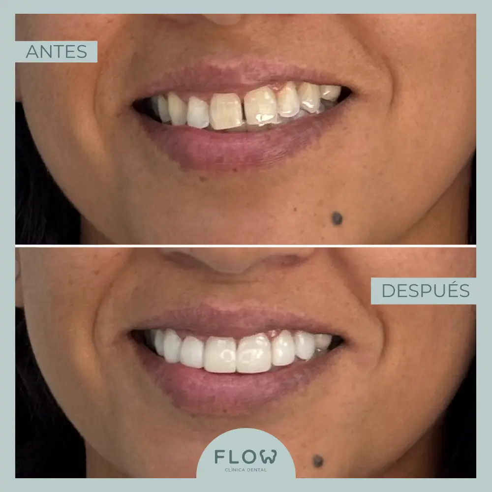 Antes y Después de tratamiento