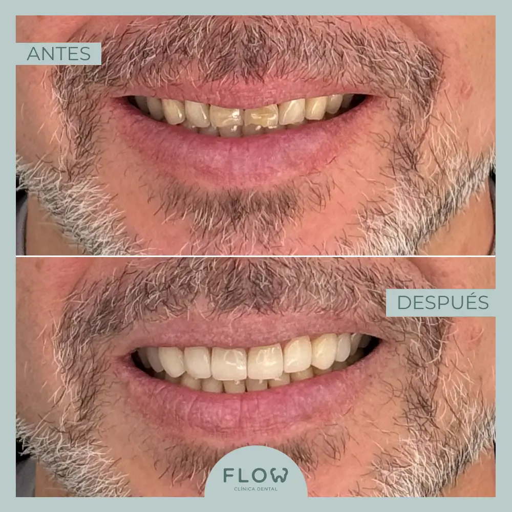 Antes y Después de tratamiento