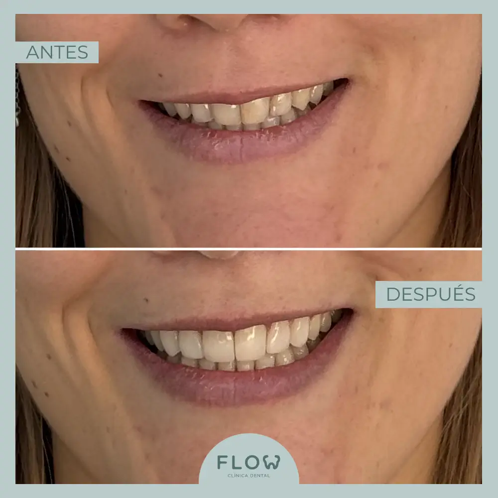 Antes y Después de tratamiento