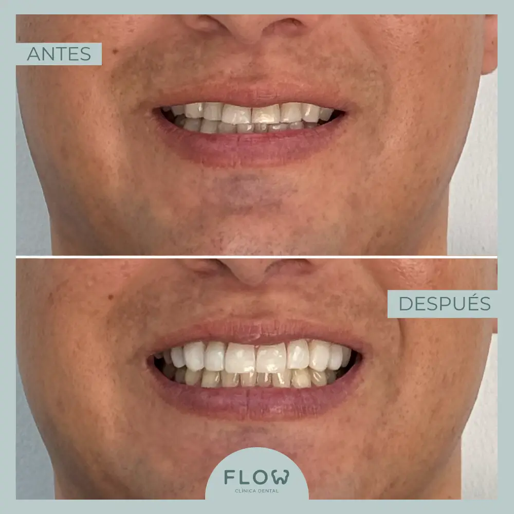 Antes y Después de tratamiento