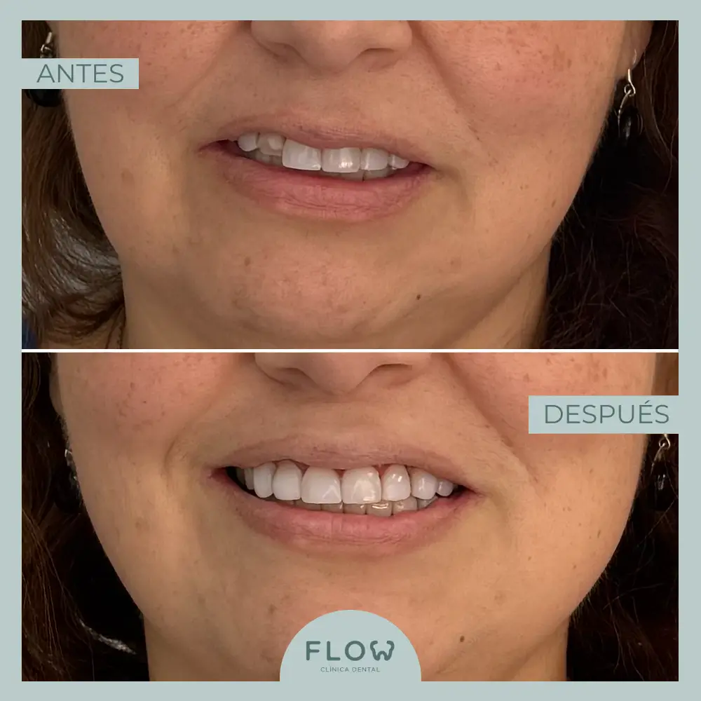 Antes y Después de tratamiento