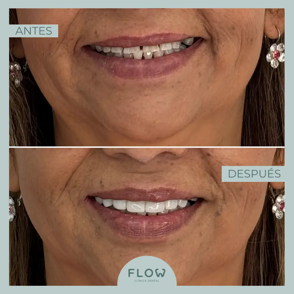 Antes y Después de tratamiento