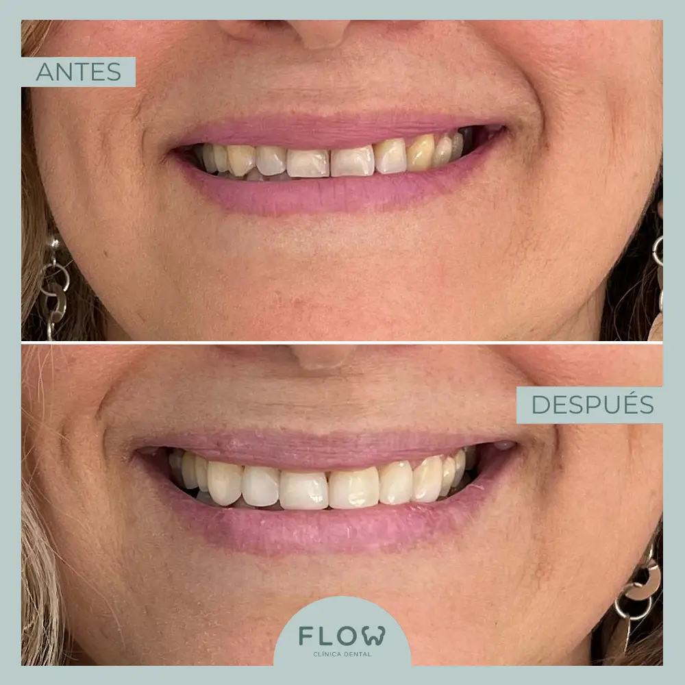 Antes y Después de tratamiento