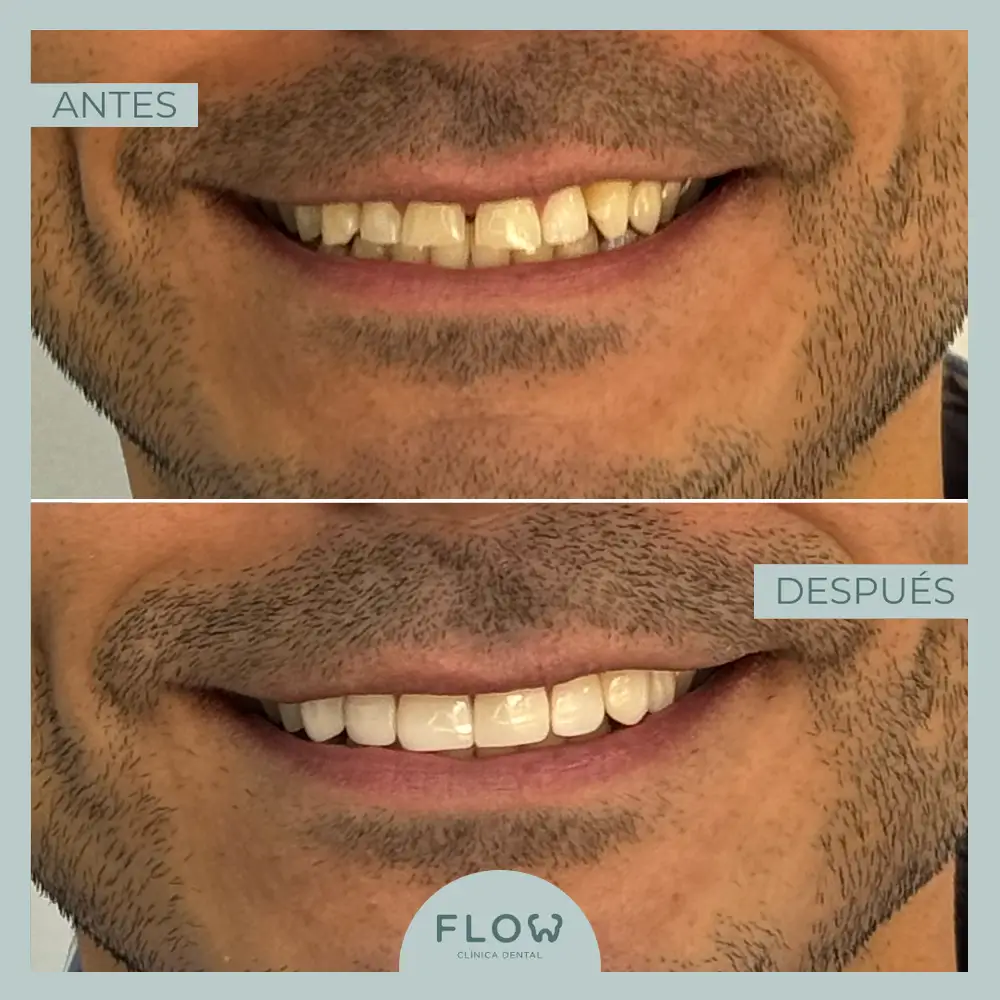 Antes y Después de tratamiento