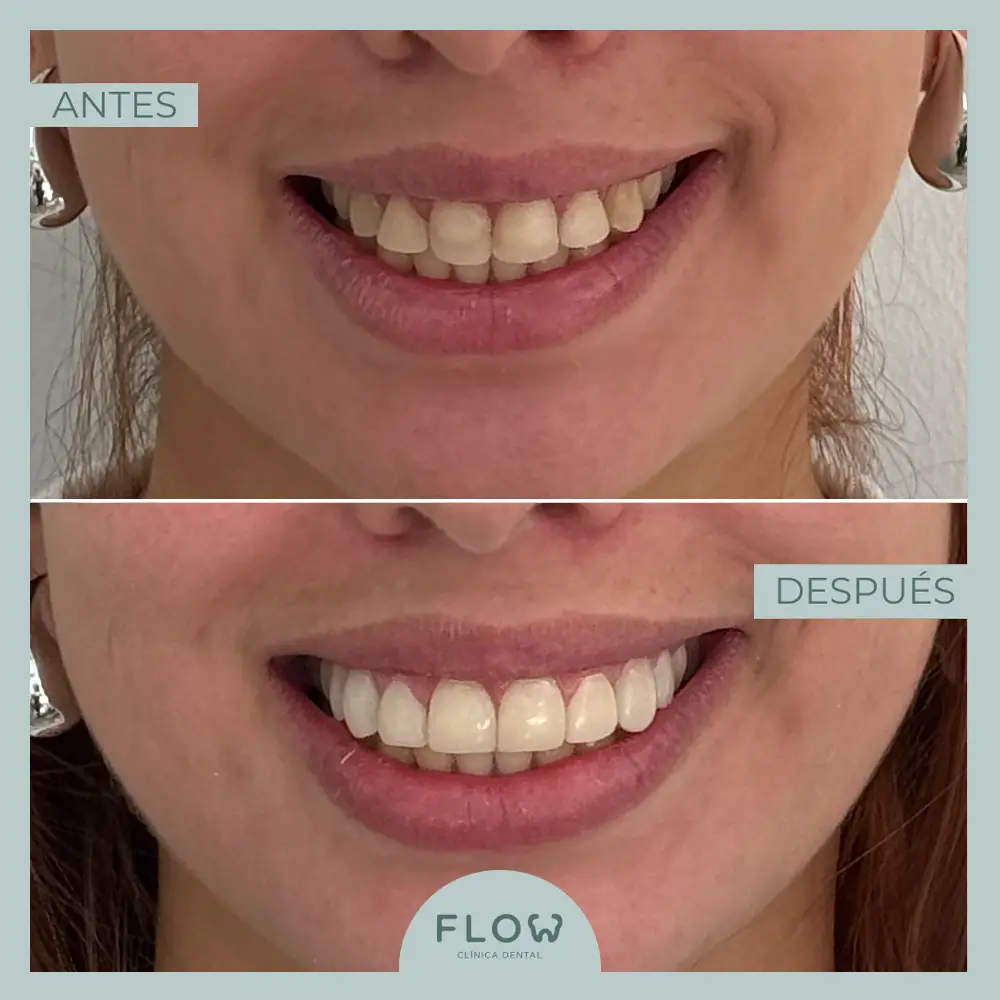 Antes y Después de tratamiento