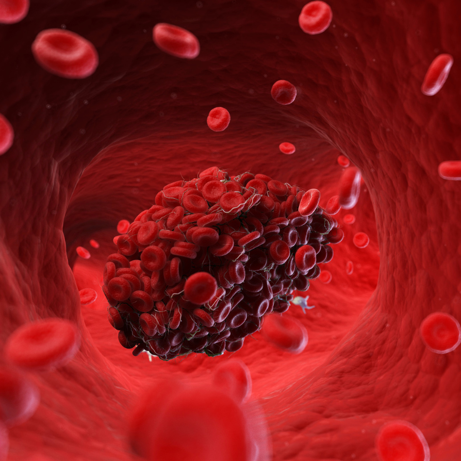 blood clot