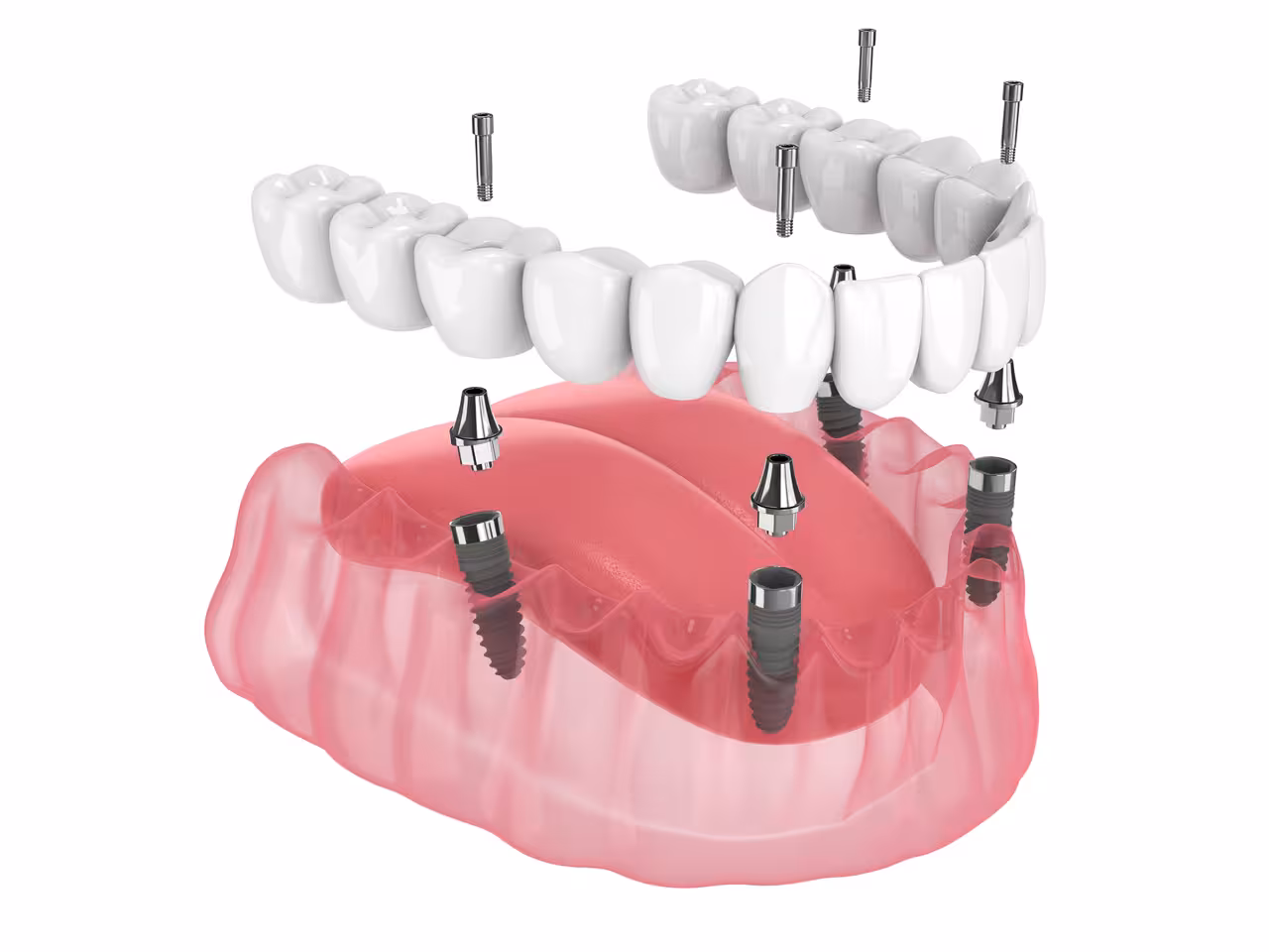 All-on-4 Dental Implants: A Permanent Alternative to Dentures in Murfreesboro