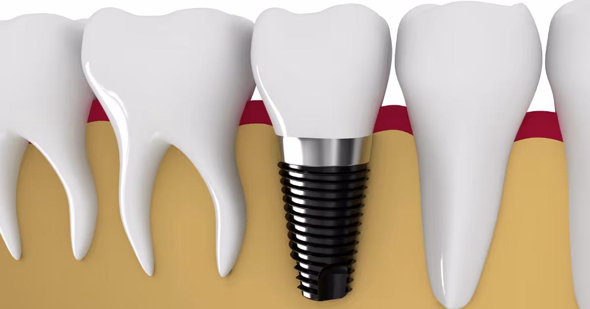 Dental Blog - How long does a dental implant procedure take?