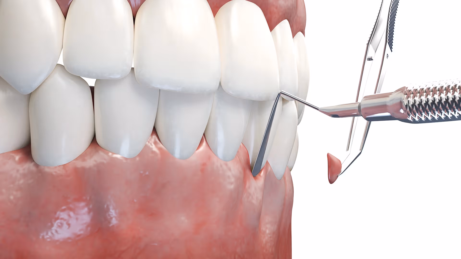 Soft Tissue (Gum) Grafting