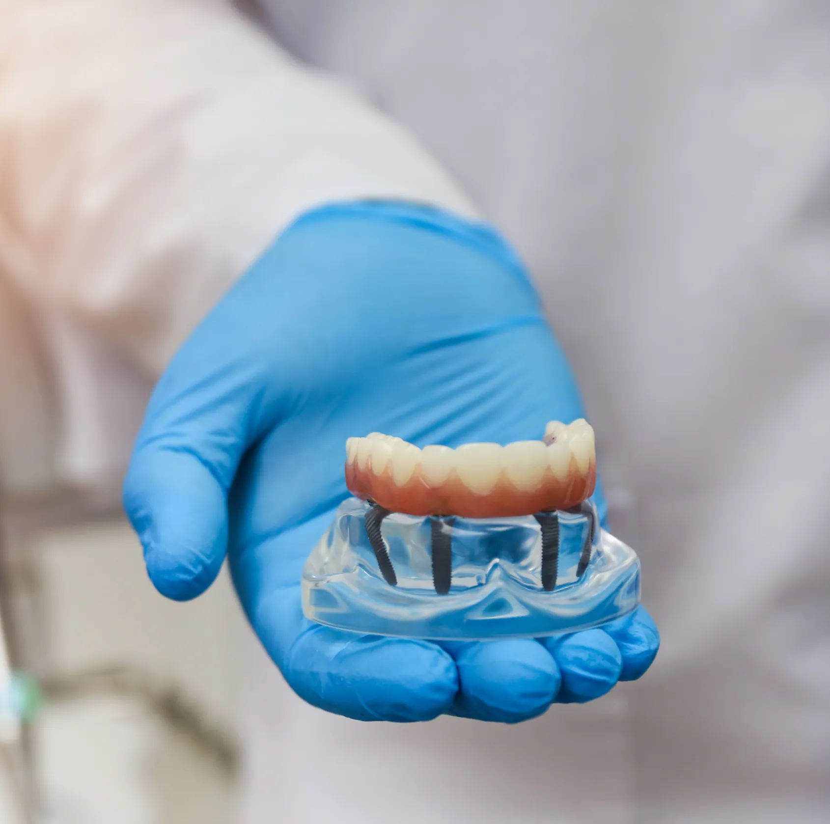 A person wearing blue gloves holds a dental implant model with teeth and metal screws.