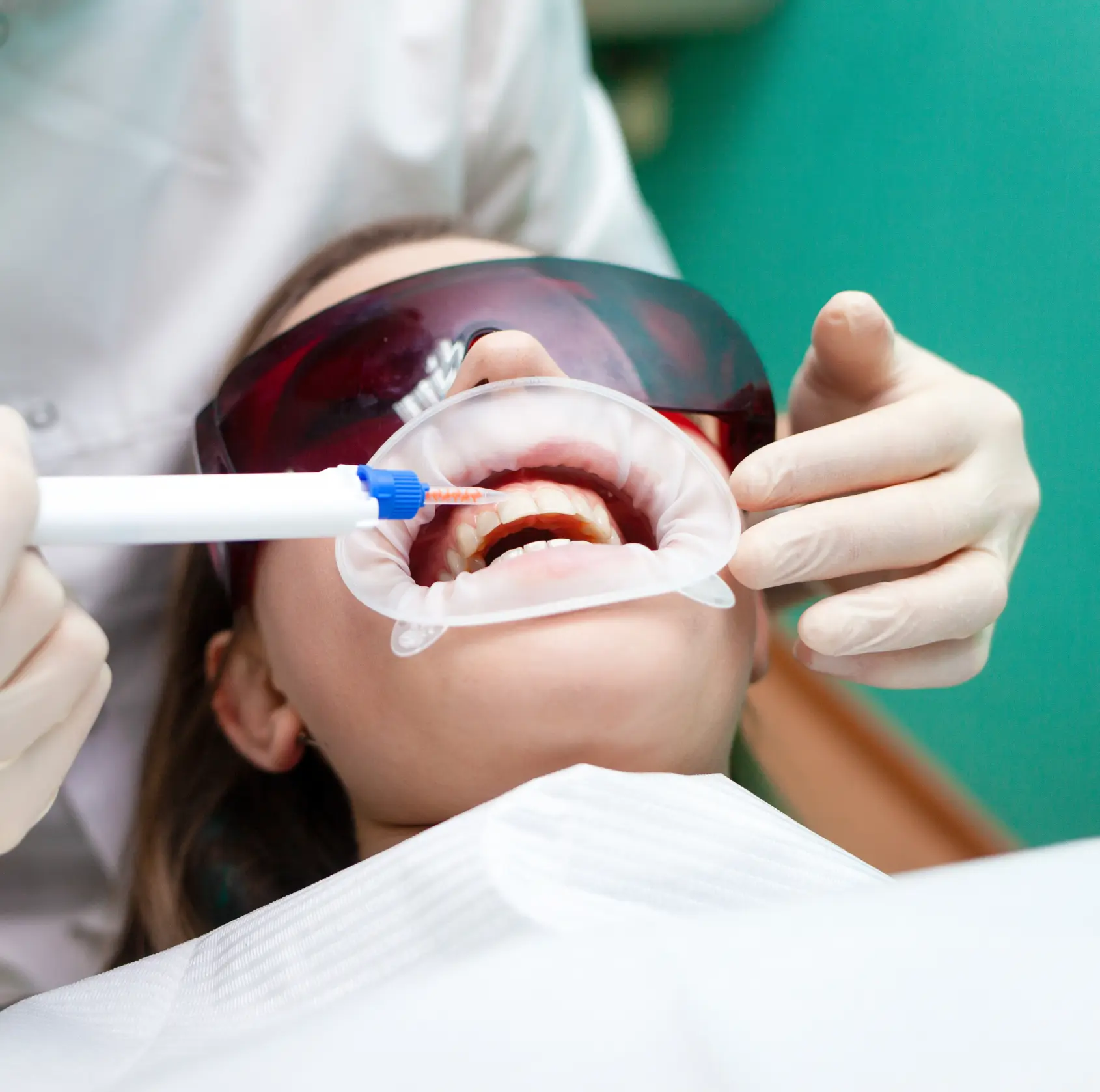 A dentist performs a whitening procedure on a patient wearing protective red glasses.