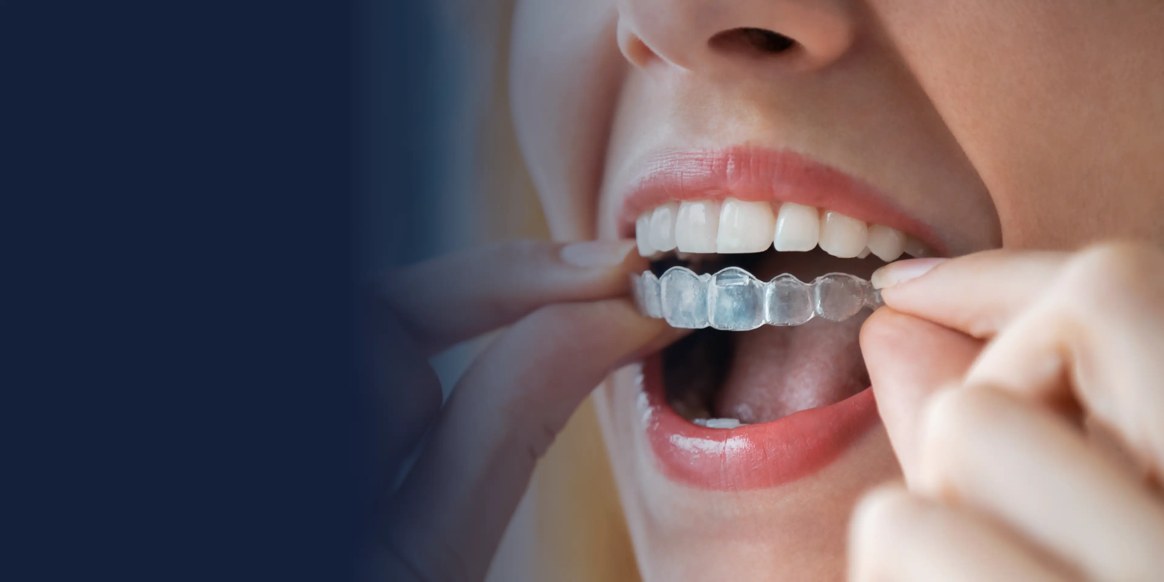 A person is putting on clear dental aligners over their teeth.