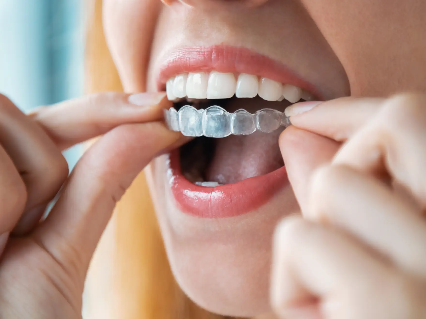A person inserts a clear dental aligner over their teeth.