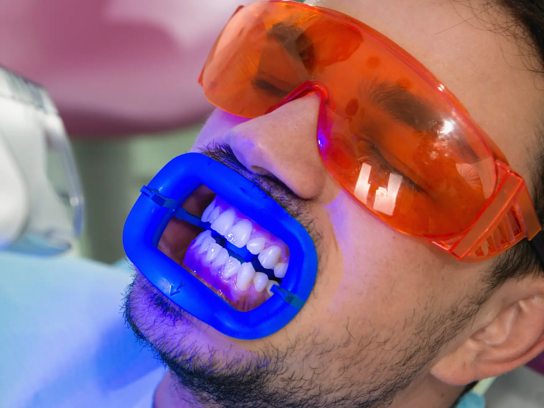 Person undergoing teeth whitening, wearing protective orange goggles and a blue mouth guard.