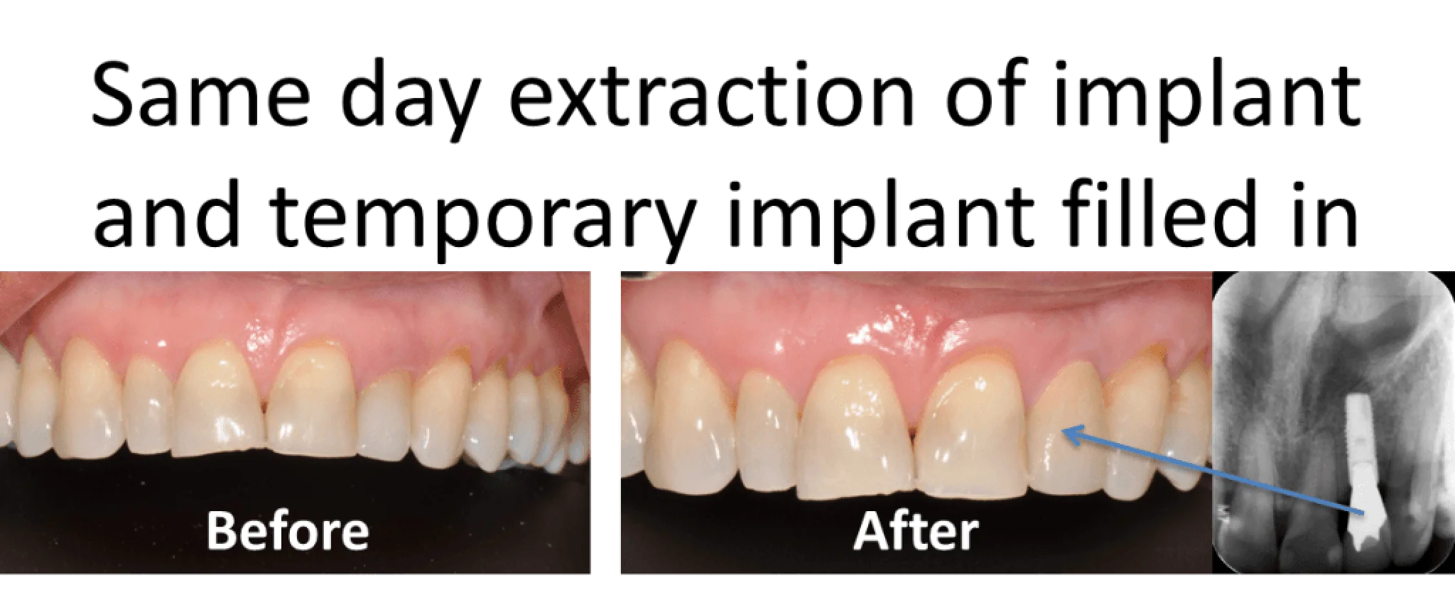 Before and after comparison of dental implant, showing improved tooth alignment and gum condition.