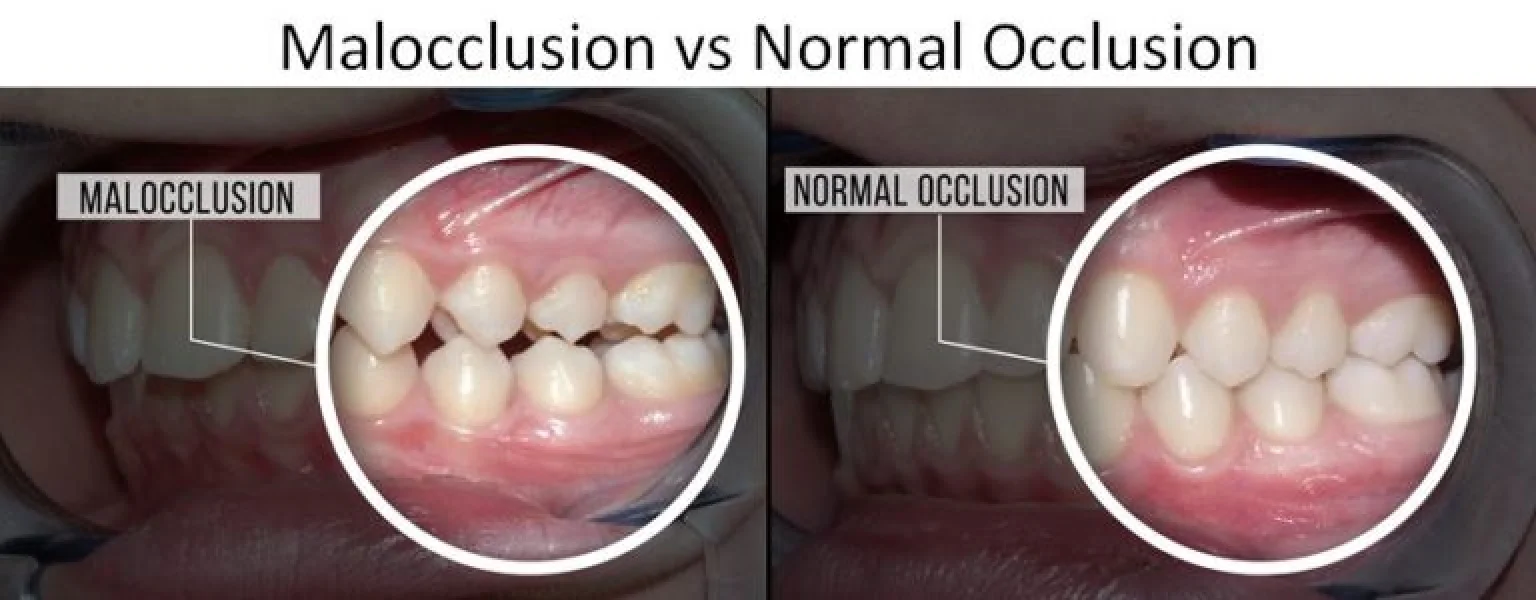 The image compares malocclusion with normal occlusion in close-up views of teeth alignment.