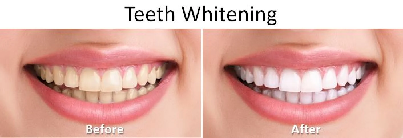Two images comparing teeth before and after whitening, showing a noticeable improvement in color.