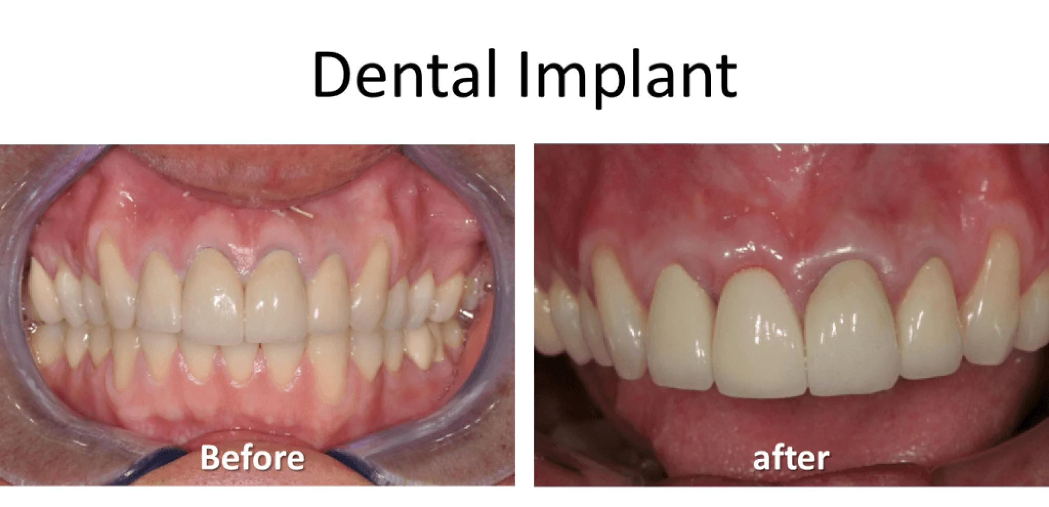 A set of teeth before and after dental treatment, showing significant improvement in alignment and color.