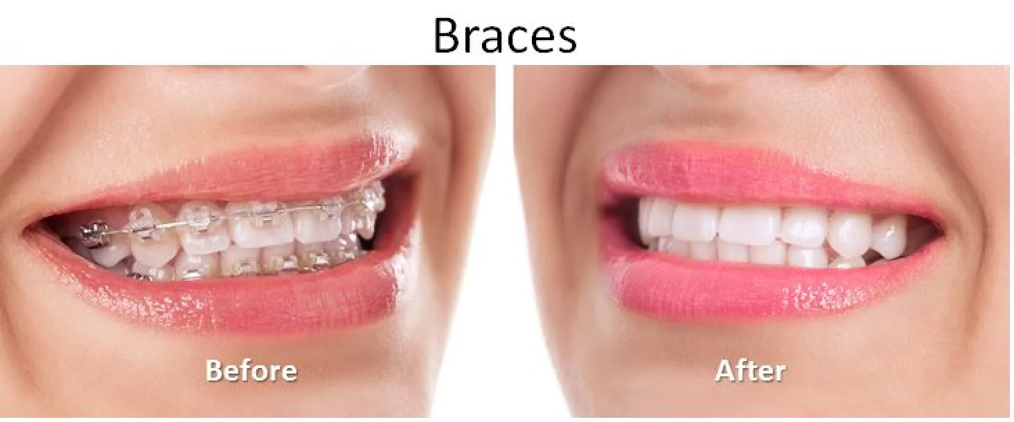 Close-up of a smile before and after braces, showing straighter teeth.