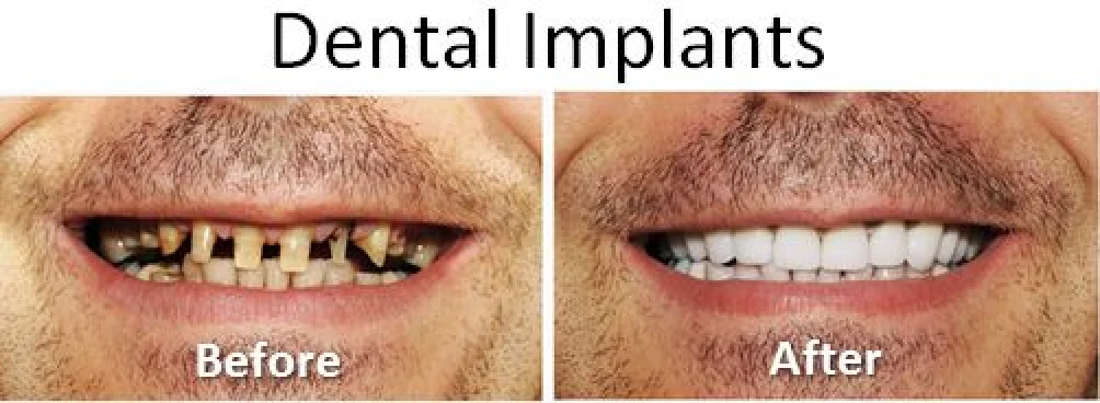 Before and after images show a person with damaged teeth replaced by dental implants.