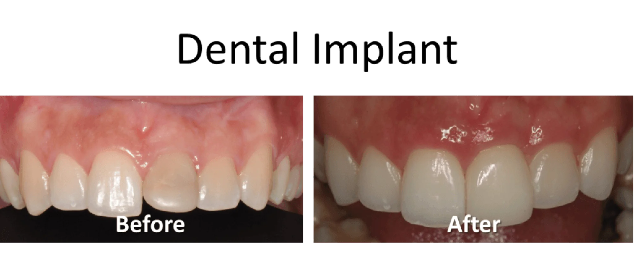 Comparison of teeth before and after dental bonding, showing improved alignment and appearance.