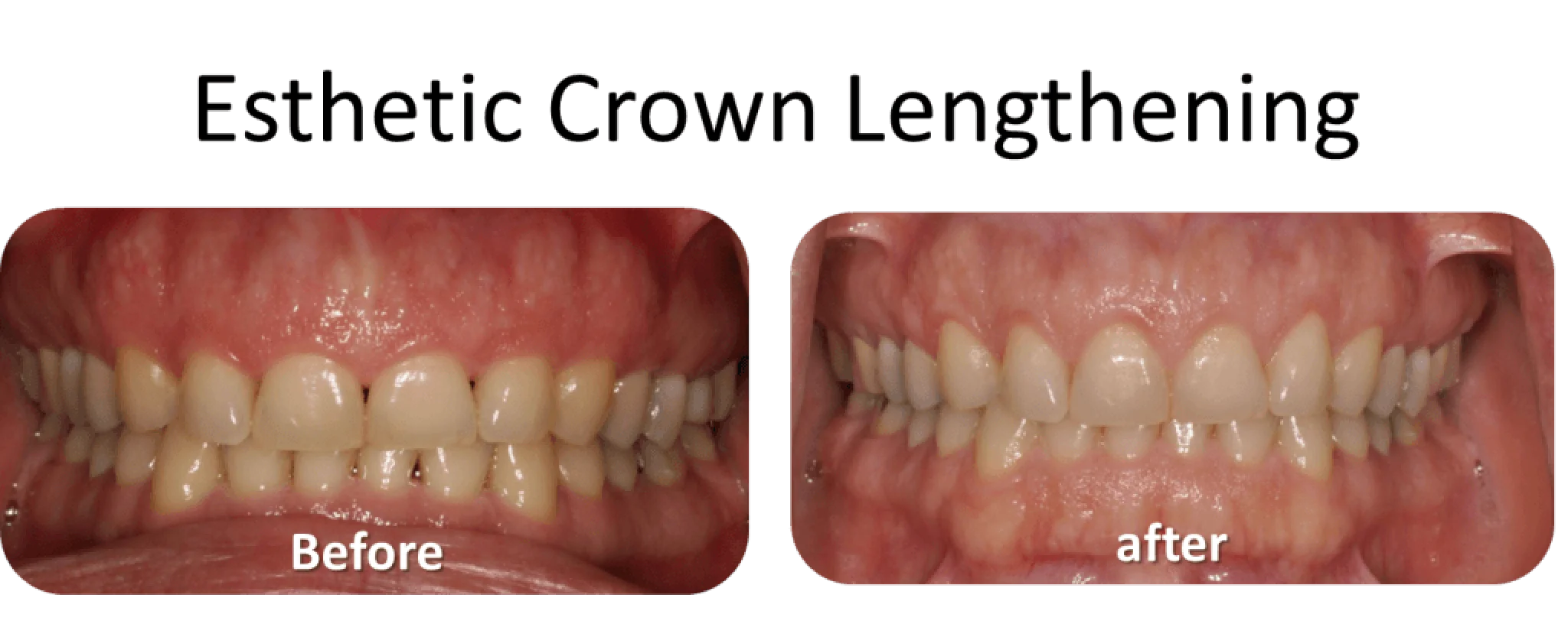Two images show teeth before and after dental crown lengthening, with gums appearing lower in the after image.