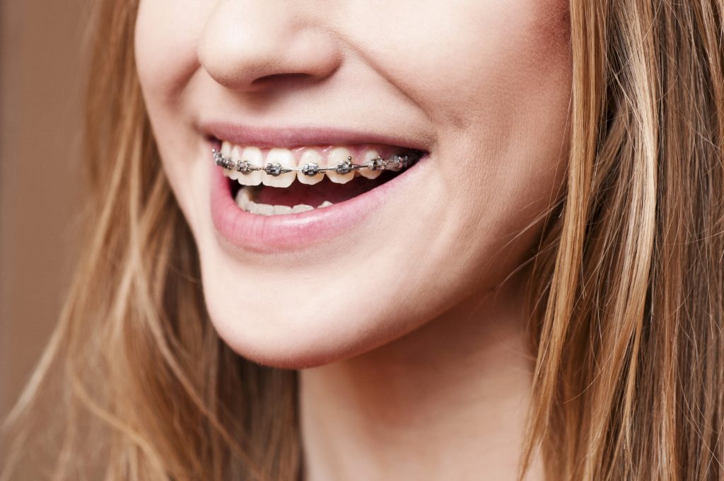 Teeth with braces