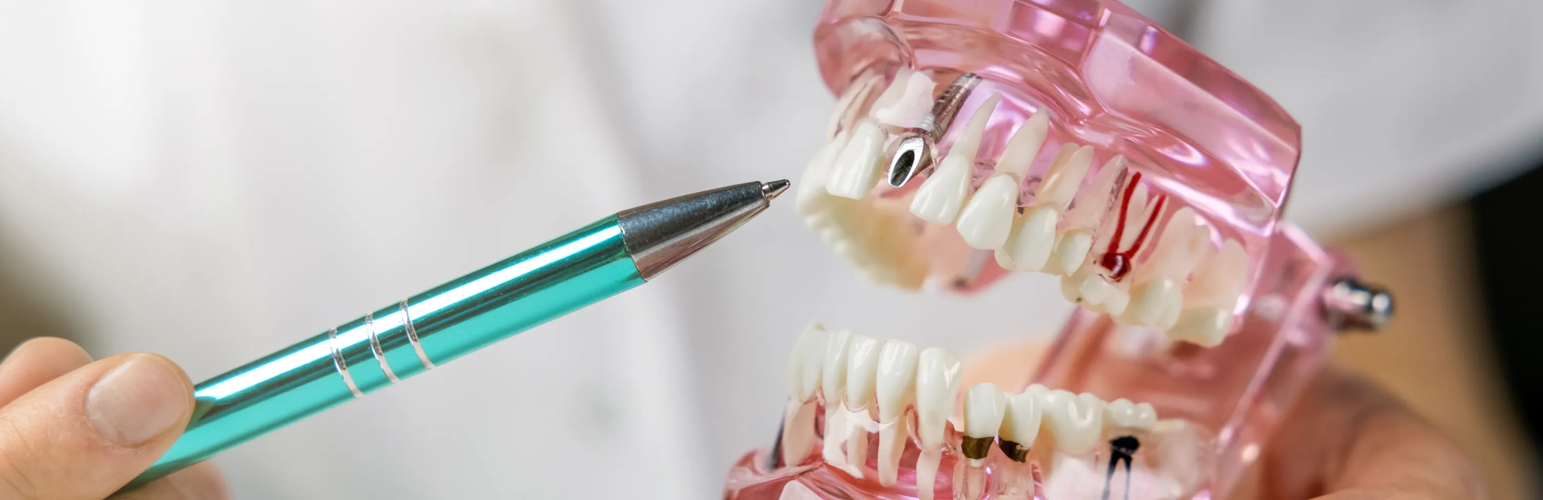 Dental Implants in Pensacola: The Ultimate Guide to Replacing Missing Teeth