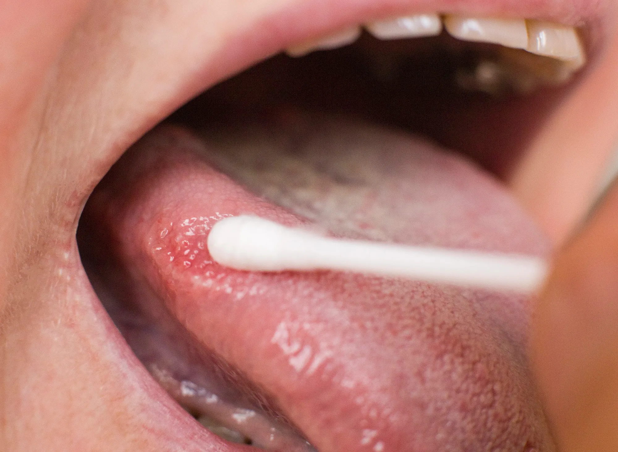 Close-up of a tongue being swabbed inside an open mouth with a cotton swab.