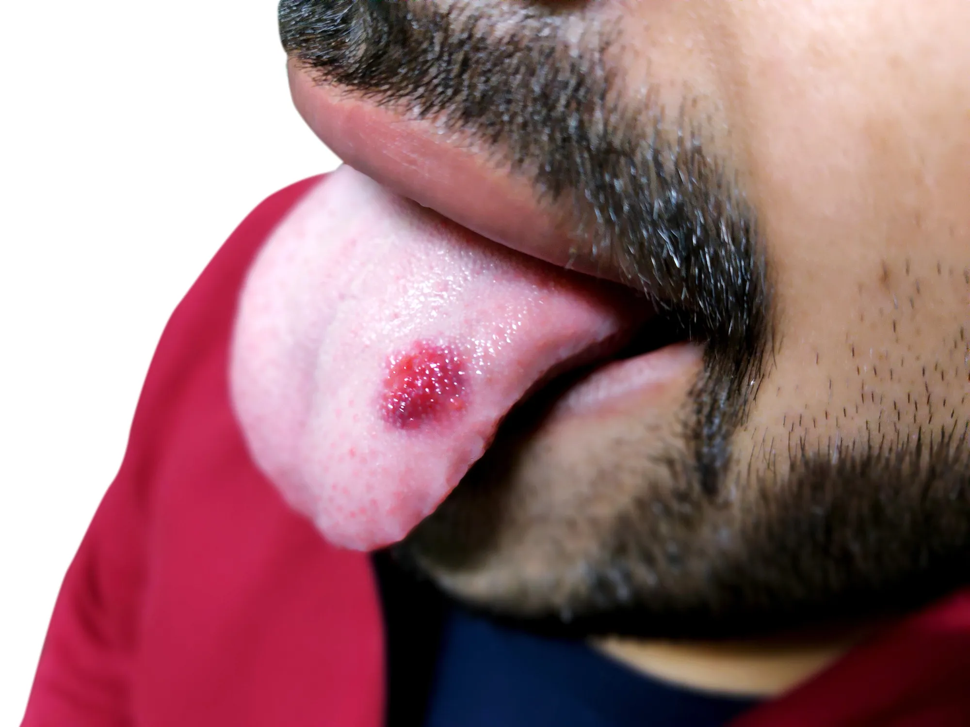 Close-up of a man showing a red sore on the tip of his tongue.