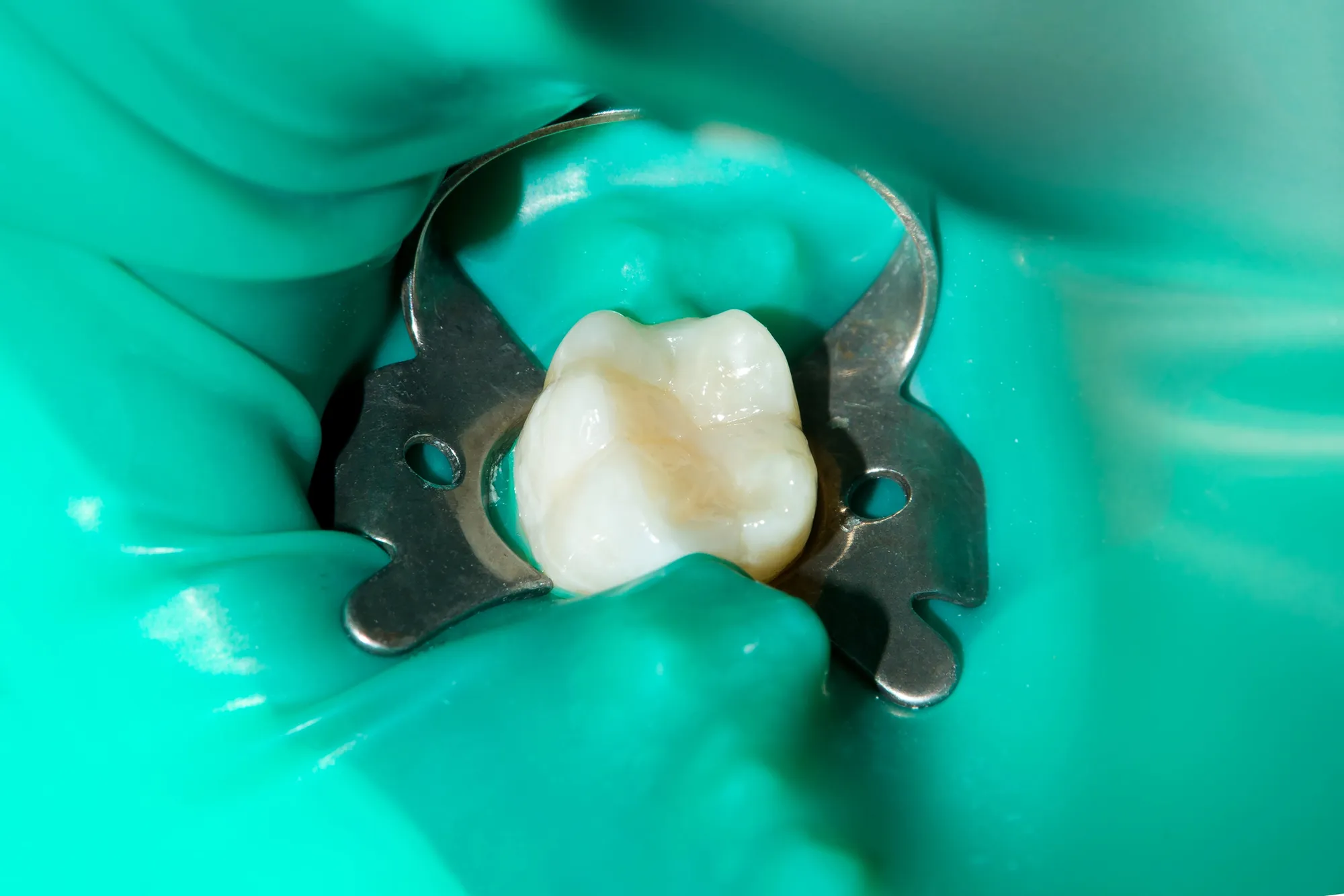 Close-up of a tooth isolated with a dental rubber dam clamp in a dental procedure.