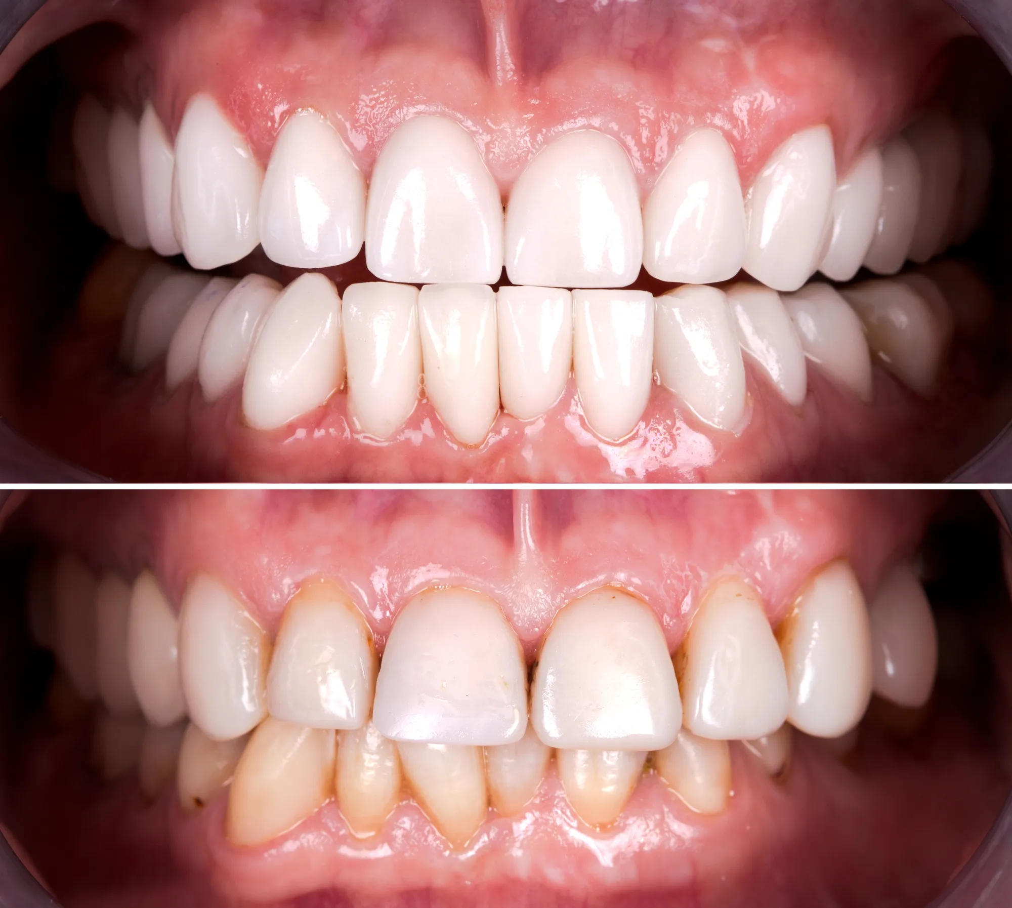 Side-by-side comparison of teeth before and after whitening treatment showing brighter teeth above.