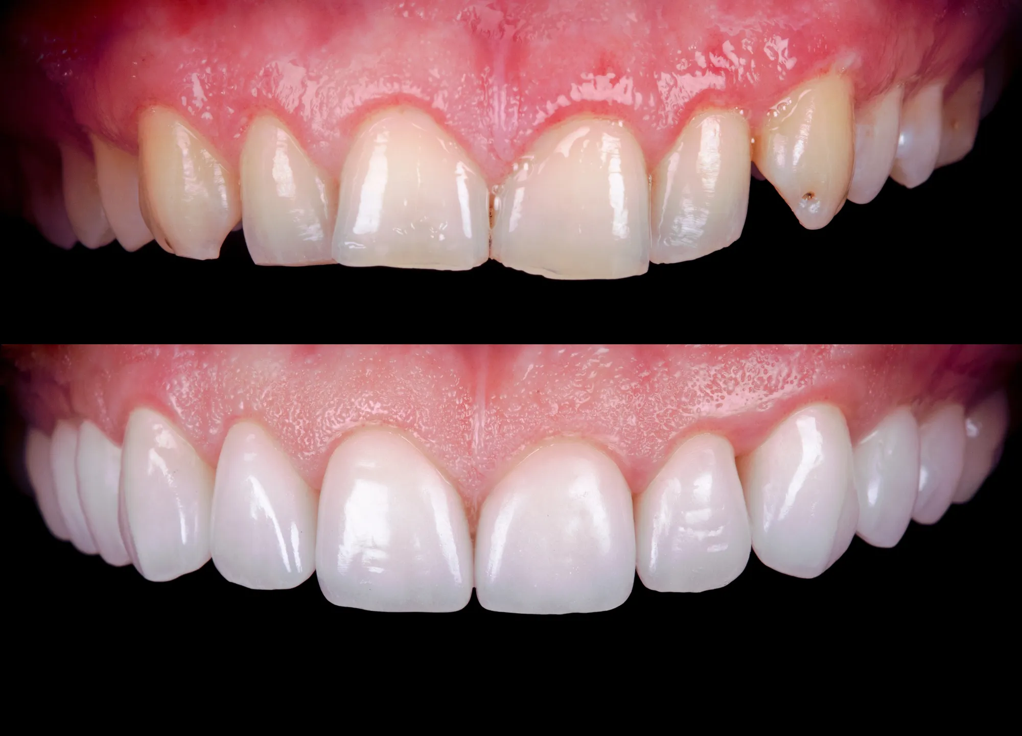 Before and after close-up of upper teeth showing significant whitening and improved shape.