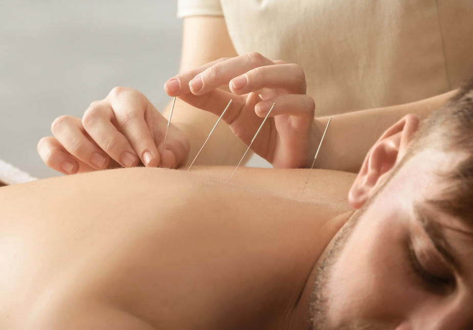 Dry Needling for shoulder