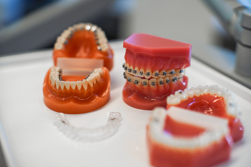 Gebissmodelle mit kieferorthopädischen Geräten: Retainer, Zahnspangen, Aufbissschiene